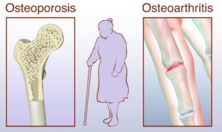 perbedaan osteoarthritis and osteoporosis yang harus diketahui