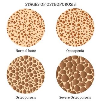 perbedaan osteoarthritis dan osteopenia