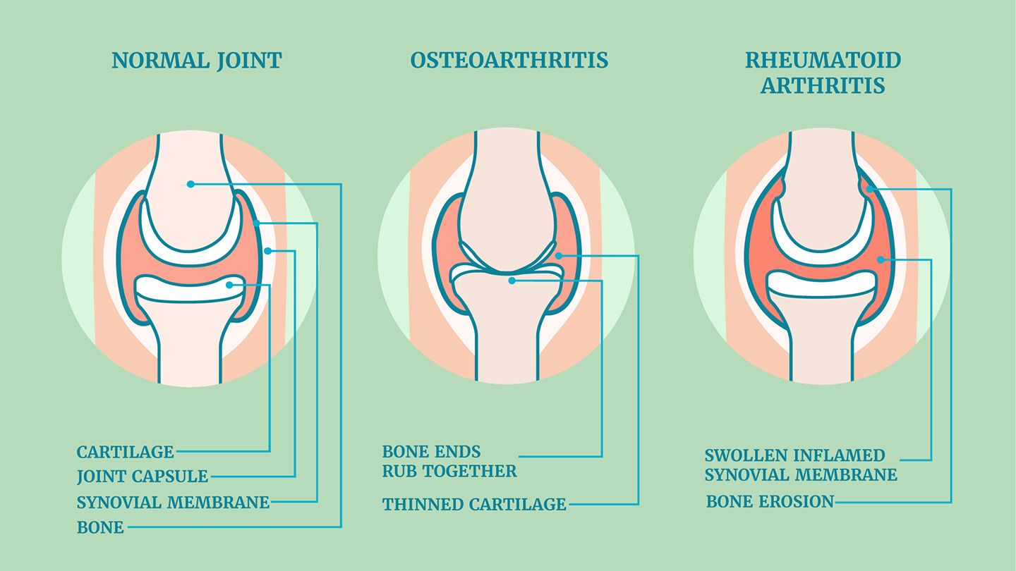 perbedaan penyakit reumatik dan osteoarthritis