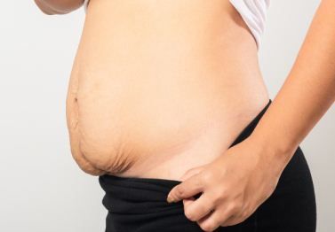 perut buncit setelah melahirkan
