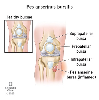 pes anserinus bursitis