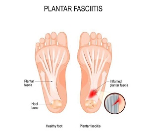 cedera maraton plantar fasciitis