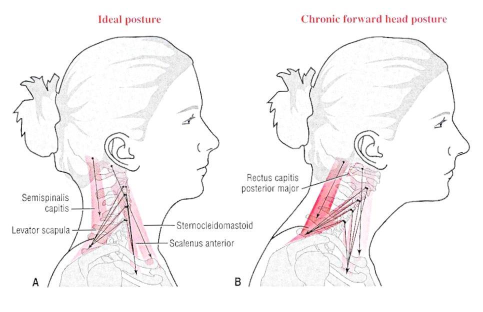 Apakah nyeri otot leher merupakan penyakit yang berbahaya