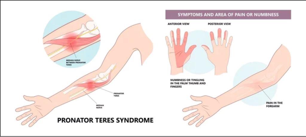 pronator teres syndrome salah satu penyebab saraf kejepit pada tangan 