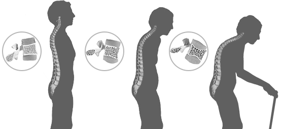 punggung membungkuk tanda awal pengeroposan tulang