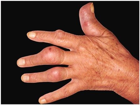 nyeri sendi jari tangan karena rheumatoid arthritis