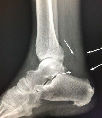 pemeriksaan sakit di tumit akibat tendon Achilles