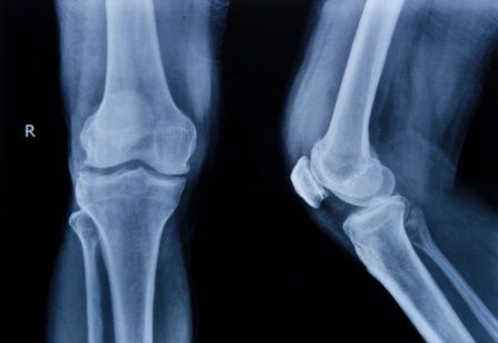 rontgen lutut untuk mencari tahu penyebab lutut sakit