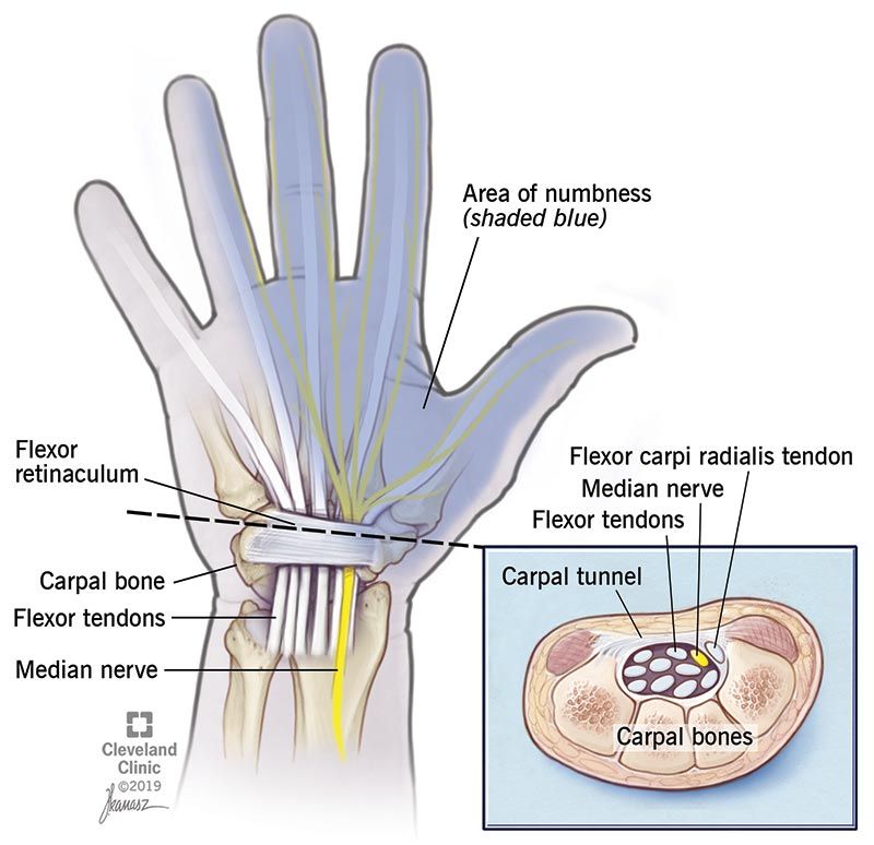 kerusakan saraf pada pasien diabetes carpal tunnel syndrome