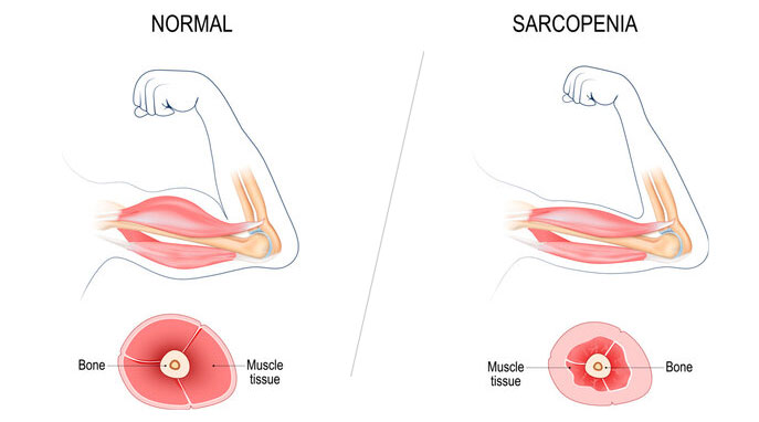 sarcopenia dan latihan kekuatan otot lansia