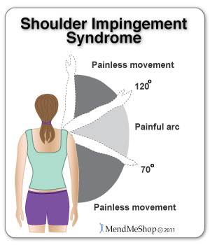 impingement syndrome
