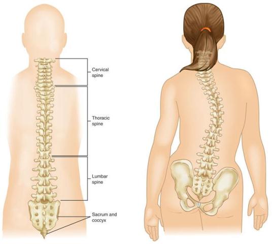 Kelainan tulang belakang yang membengkok kekanan atau kekiri disebut