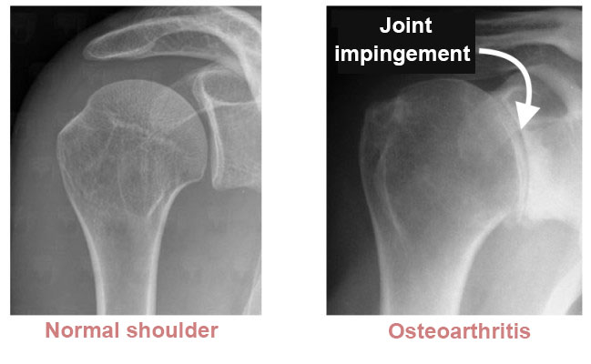 tanda pengapuran sendi bahu pada rontgen