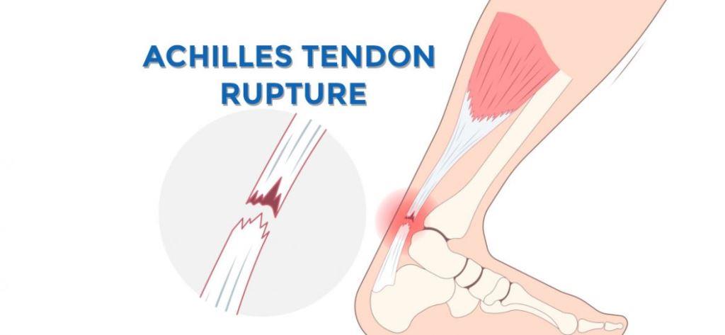 tanda tendon pergelangan kaki robek