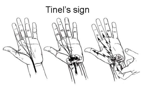 Tinel's sign