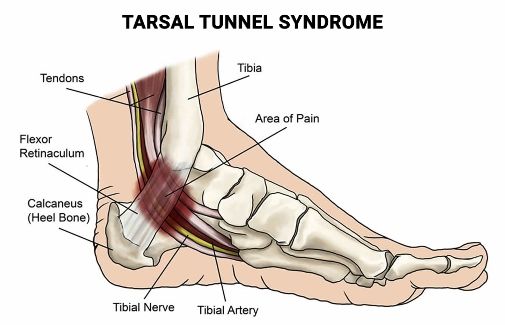 tarsal tunnel syndrome penyebab kesemutan di kaki