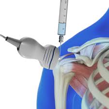 teknik barbotage untuk terapi tendinopati kalsifikasi pada rotator cuff