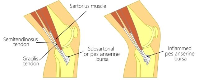 sakit lutut bagian dalam