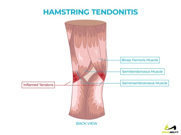 tendonitis hamstring