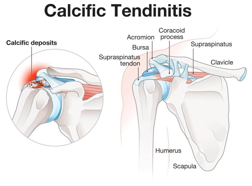 tendonitis kalsifikasi pada prosedur barbotage