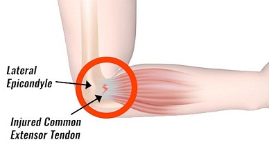 tennis elbow