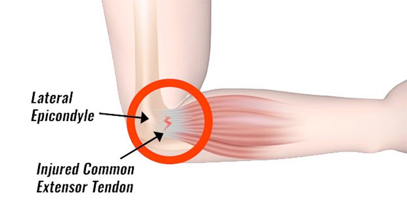 tennis elbow penyebab sakit siku tersering