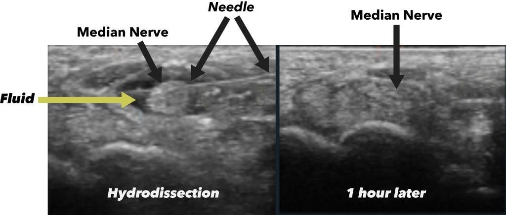 terapi hidrodiseksi pada carpal tunnel syndrome