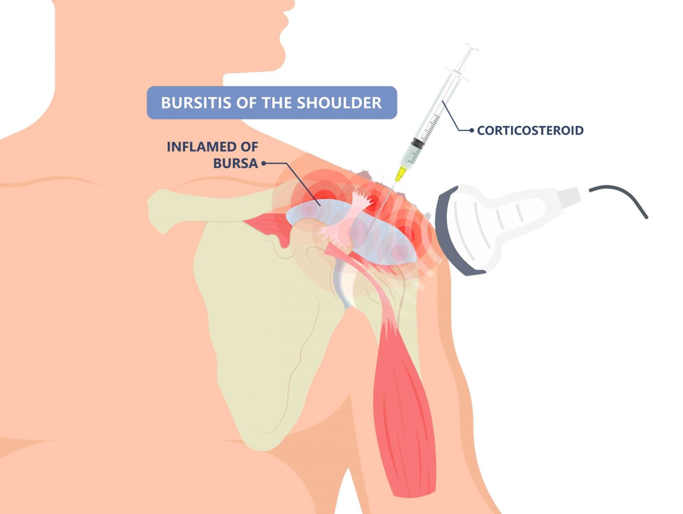 terapi injeksi untuk penyebab sakit pundak bursitis