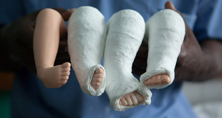 terapi kelainan club foot dengan gips