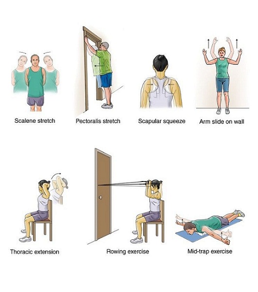latihan untuk mengatasi nyeri leher menjalar akibat thoracic outlet syndrome
