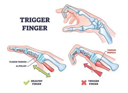 trigger finger