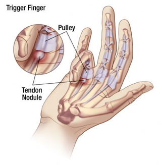 trigger finger penyebab jari tangan kaku dan sakit saat ditekuk