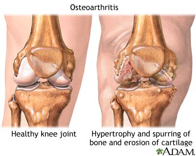 gambaran Osteorthritis OA